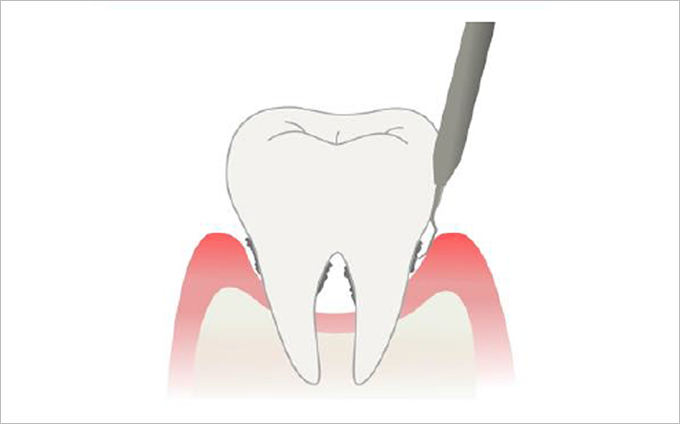 口腔内スキャナー